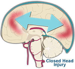 closed head injury